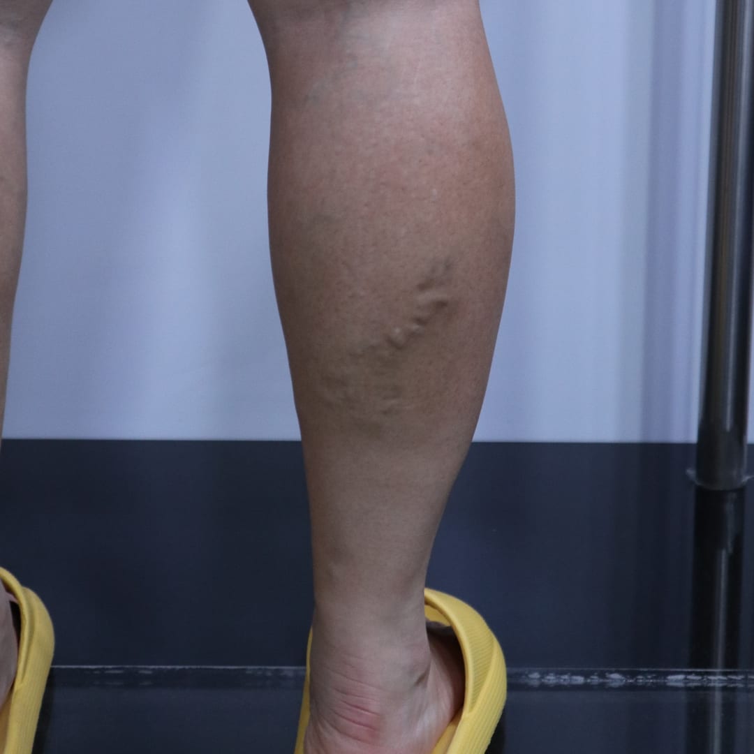 하지정맥류 치료, 시술 종류보다 먼저 확인해야 할 것